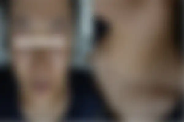 지루성피부염 치료 후 사진 — 부천점, 치료 기간 3개월