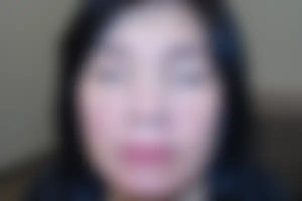 지루성피부염 치료 후 사진 — 천안아산점, 치료 기간 3개월