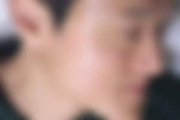 지루성피부염 치료 후 사진 — 수원점, 치료 기간 3개월