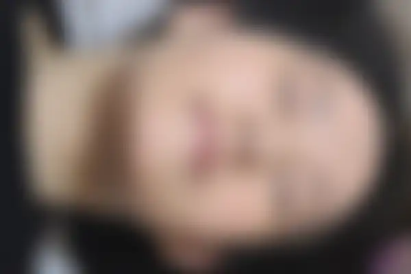 지루성피부염 치료 후 사진 — 수원점, 치료 기간 2주