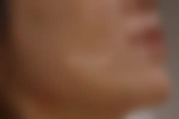 지루성피부염 치료 후 사진 — 분당점, 치료 기간 3개월
