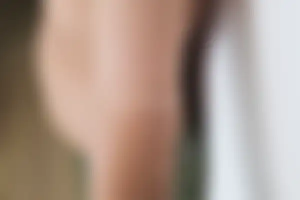 소아아토피 치료 후 사진 — 창원점, 치료 기간 6개월