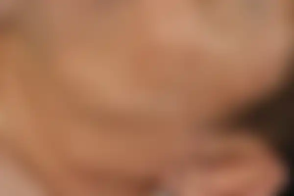 지루성피부염 치료 후 사진 — 분당점, 치료 기간 5개월
