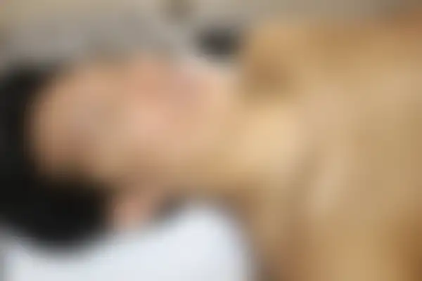지루성피부염 치료 후 사진 — 수원점, 치료 기간 5개월