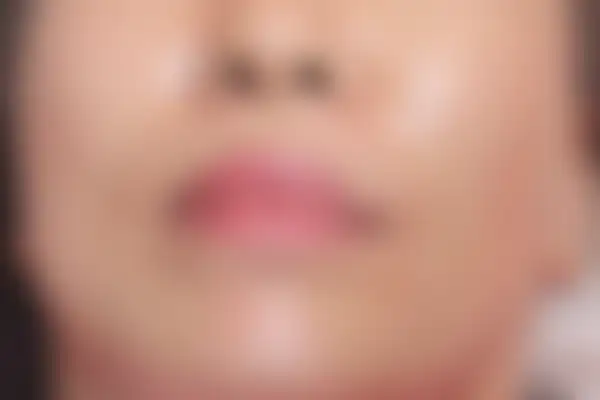지루성피부염 치료 후 사진 — 수원점, 치료 기간 1개월