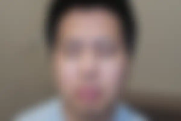 지루성피부염 치료 후 사진 — 천안아산점, 치료 기간 4개월