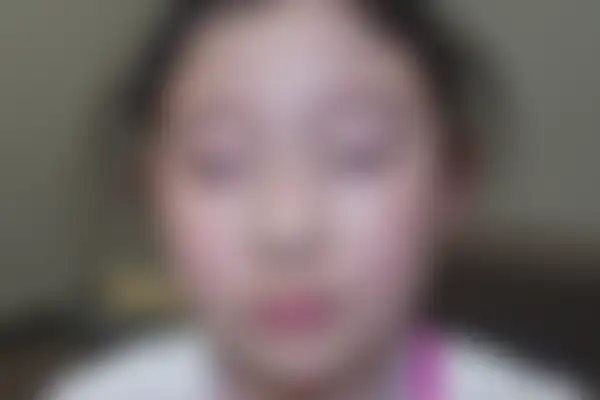 소아아토피 치료 후 사진 — 천안아산점, 치료 기간 4개월