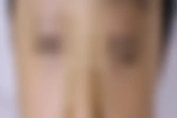 소아아토피 치료 후 사진 — 인천점, 치료 기간 6개월