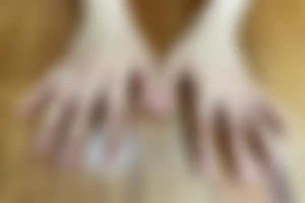 아토피 치료 후 사진 — 잠실점, 치료 기간 8개월