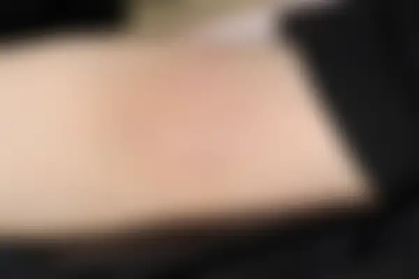 아토피 치료 후 사진 — 분당점, 치료 기간 4개월
