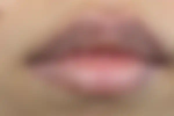 습진 치료 후 사진 — 부천점, 치료 기간 3개월