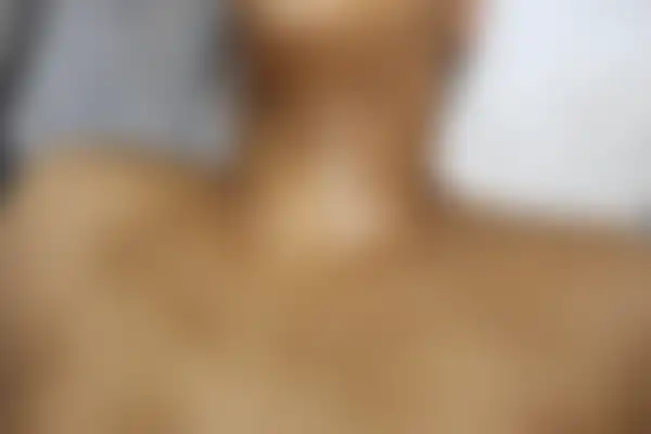 아토피 치료 후 사진 — 수원점, 치료 기간 4개월
