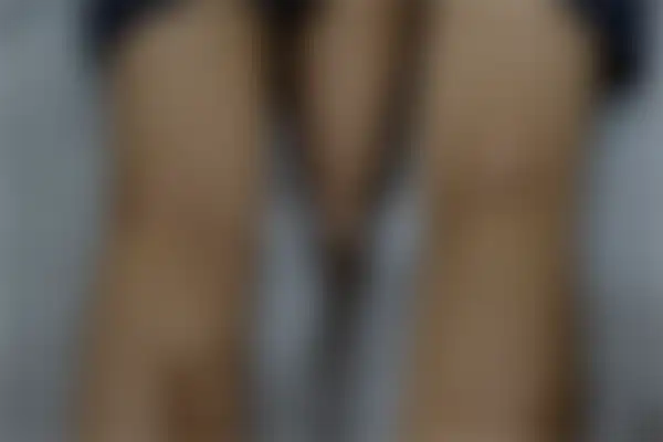 아토피 치료 후 사진 — 부천점, 치료 기간 5개월