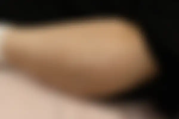 아토피 치료 후 사진 — 분당점, 치료 기간 3개월