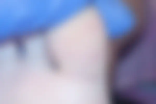 사마귀 치료 후 사진 — 천안아산점, 치료 기간 3개월