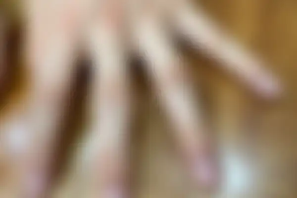 사마귀 치료 후 사진 — 잠실점, 치료 기간 9개월