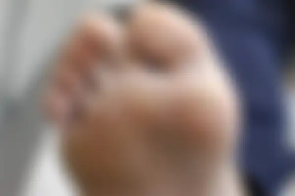 사마귀 치료 후 사진 — 수원점, 치료 기간 9개월