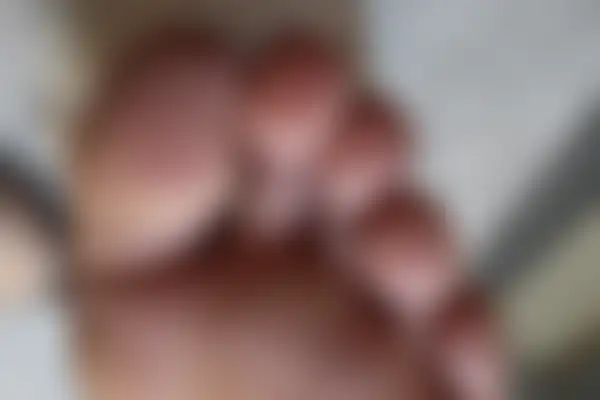 사마귀 치료 후 사진 — 수원점, 치료 기간 9개월