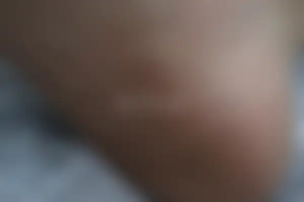 사마귀 치료 후 사진 — 대전점, 치료 기간 6개월